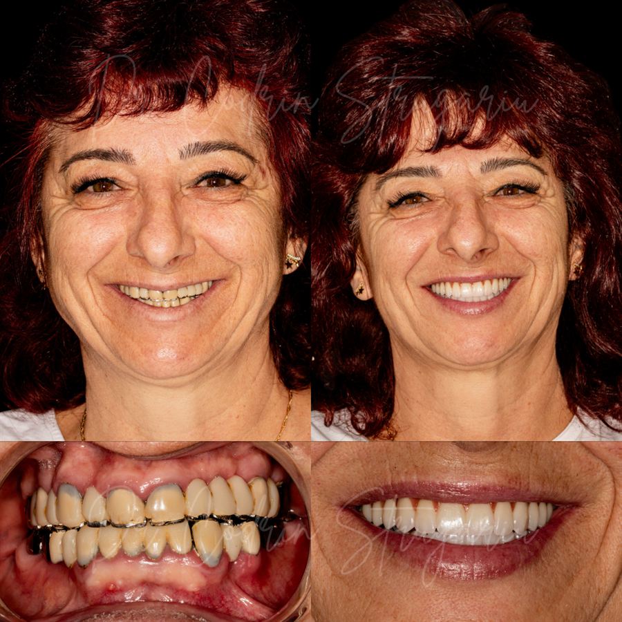 Caz reabilitare orală pe implanturi — înainte și după